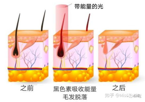 煥現絲滑肌膚｜榮獲設計大獎的紅光強脈沖脫毛儀使用推薦